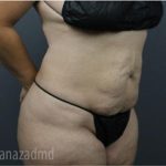 Tummy Tuck Before & After Patient #2865