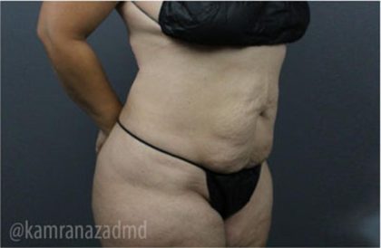 Tummy Tuck Before & After Patient #2865