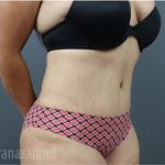Tummy Tuck Before & After Patient #2865