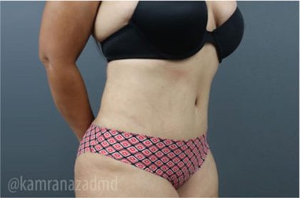 Tummy Tuck Before & After Patient #2865