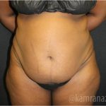 Tummy Tuck Before & After Patient #2866