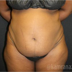 Tummy Tuck Before & After Patient #2866