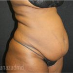 Tummy Tuck Before & After Patient #2866