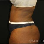 Tummy Tuck Before & After Patient #2866