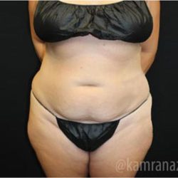 Tummy Tuck Before & After Patient #2867