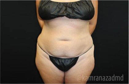 Tummy Tuck Before & After Patient #2867