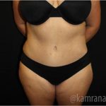 Tummy Tuck Before & After Patient #2867