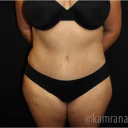 Tummy Tuck Before & After Patient #2867