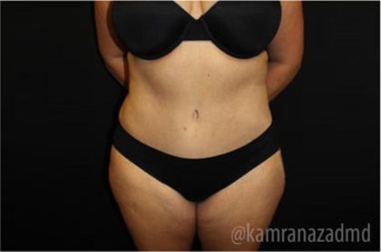 Tummy Tuck Before & After Patient #2867