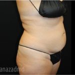 Tummy Tuck Before & After Patient #2867