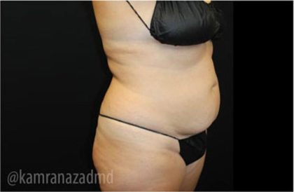 Tummy Tuck Before & After Patient #2867