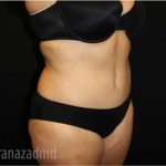 Tummy Tuck Before & After Patient #2867