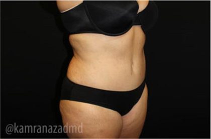 Tummy Tuck Before & After Patient #2867