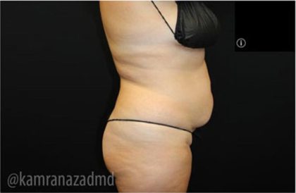 Tummy Tuck Before & After Patient #2867