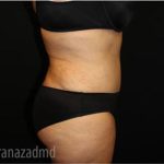 Tummy Tuck Before & After Patient #2867
