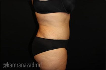 Tummy Tuck Before & After Patient #2867