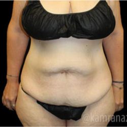 Tummy Tuck Before & After Patient #2868