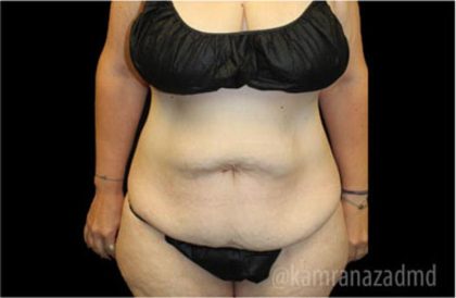 Tummy Tuck Before & After Patient #2868