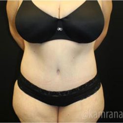 Tummy Tuck Before & After Patient #2868