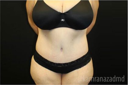 Tummy Tuck Before & After Patient #2868