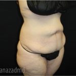 Tummy Tuck Before & After Patient #2868