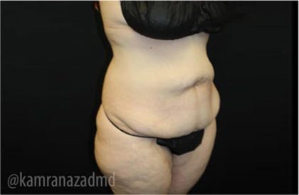 Tummy Tuck Before & After Patient #2868