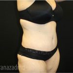 Tummy Tuck Before & After Patient #2868