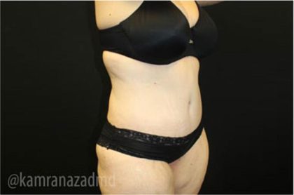Tummy Tuck Before & After Patient #2868