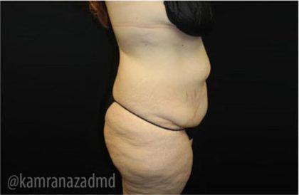 Tummy Tuck Before & After Patient #2868