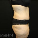 Tummy Tuck Before & After Patient #2868
