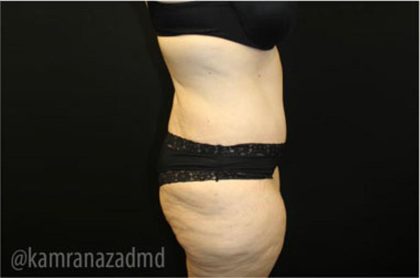 Tummy Tuck Before & After Patient #2868