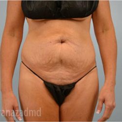 Tummy Tuck Before & After Patient #2869
