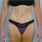 Tummy Tuck Before & After Patient #2869