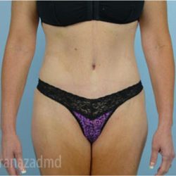 Tummy Tuck Before & After Patient #2869