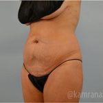 Tummy Tuck Before & After Patient #2869