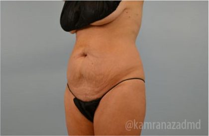 Tummy Tuck Before & After Patient #2869