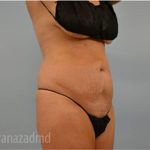 Tummy Tuck Before & After Patient #2869