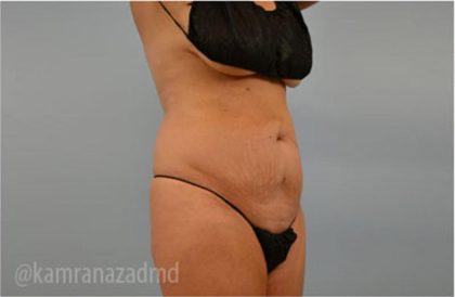 Tummy Tuck Before & After Patient #2869