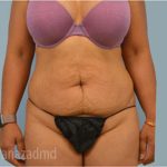 Tummy Tuck Before & After Patient #2870