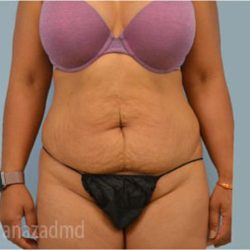 Tummy Tuck Before & After Patient #2870
