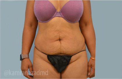 Tummy Tuck Before & After Patient #2870