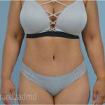 Tummy Tuck Before & After Patient #2870
