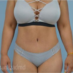 Tummy Tuck Before & After Patient #2870