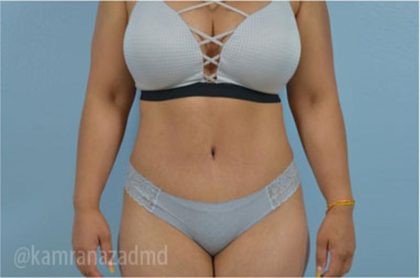 Tummy Tuck Before & After Patient #2870