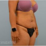 Tummy Tuck Before & After Patient #2870