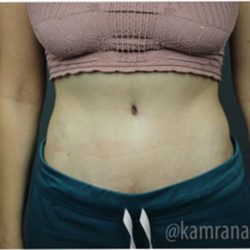 Tummy Tuck Before & After Patient #2827