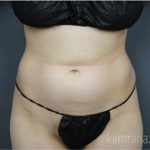 Tummy Tuck Before & After Patient #2827