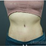 Tummy Tuck Before & After Patient #2827
