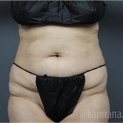 Tummy Tuck Before & After Patient #2828
