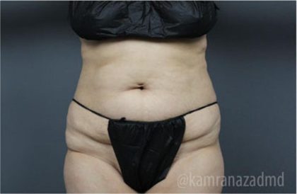 Tummy Tuck Before & After Patient #2828